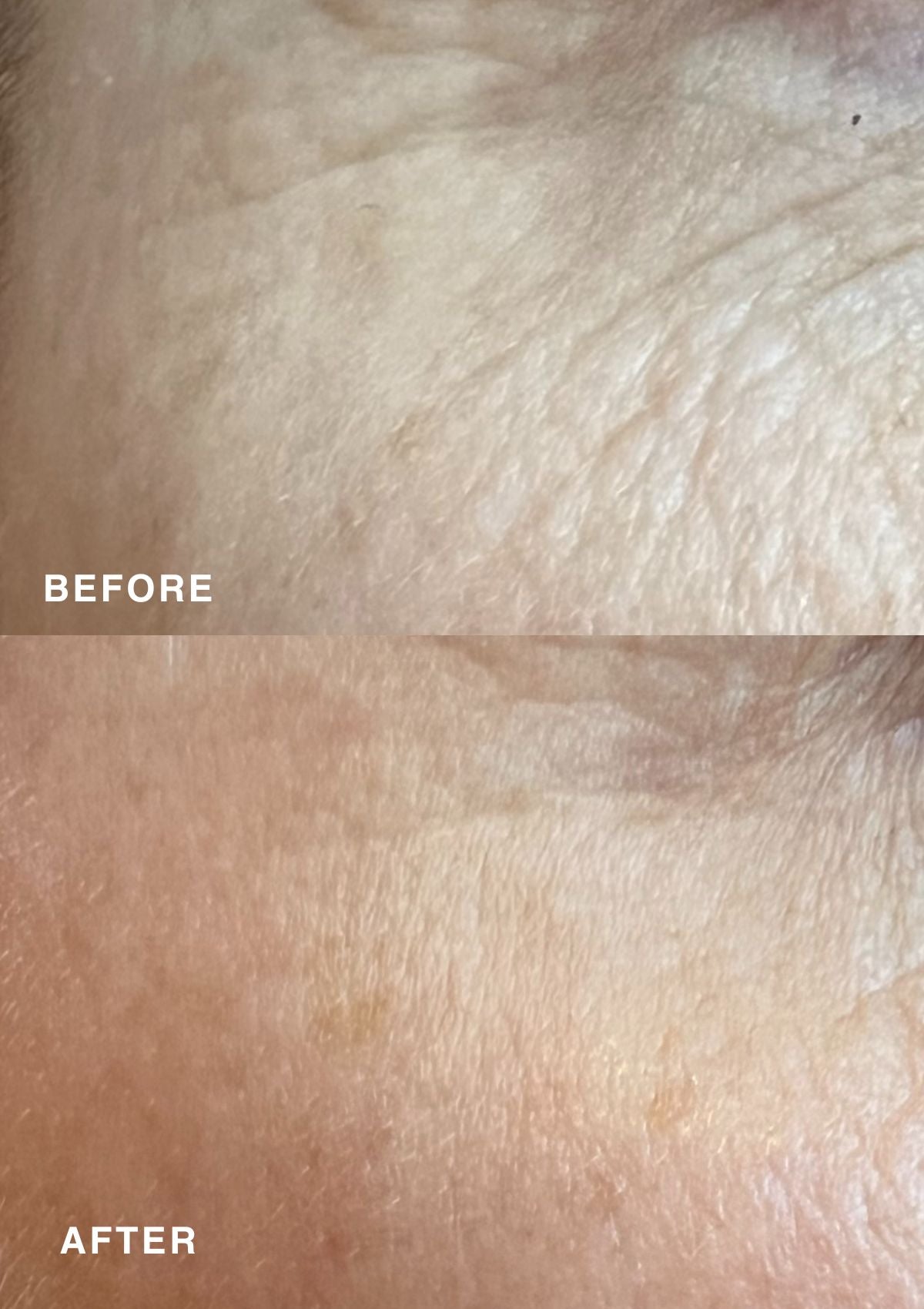 Before and after comparison of skin texture with 'Before' on top and 'After' on bottom.