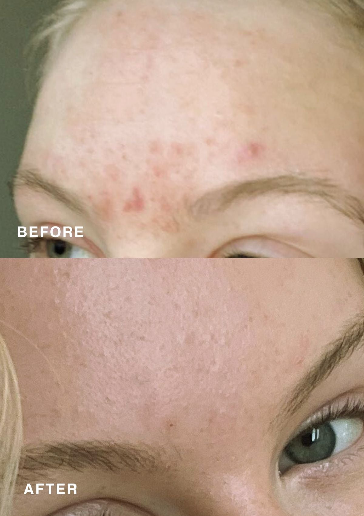 Before and after comparison of a person's face with acne on the left and smooth skin on the right.